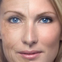 Wrinkle Removal in Toronto